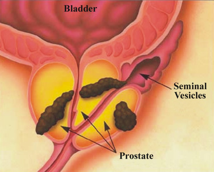 Предстательная железа витамины. Prostate Cancer Staging. Мужские болезни по урологии. Аденома простаты у собак.