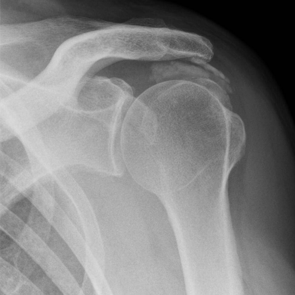 Саркома юинга плечевой кости рентген. Кальцинирующий тендинит коленного сустава рентген. Оссифицированный тендинит. Кальцифицирующий тендинит плеча. Оссифицированный тендинит.